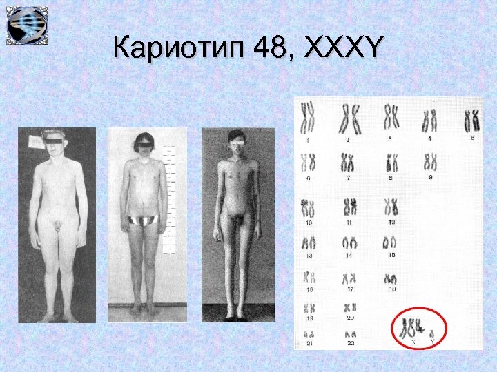 Кариотип 48, ХХХY 