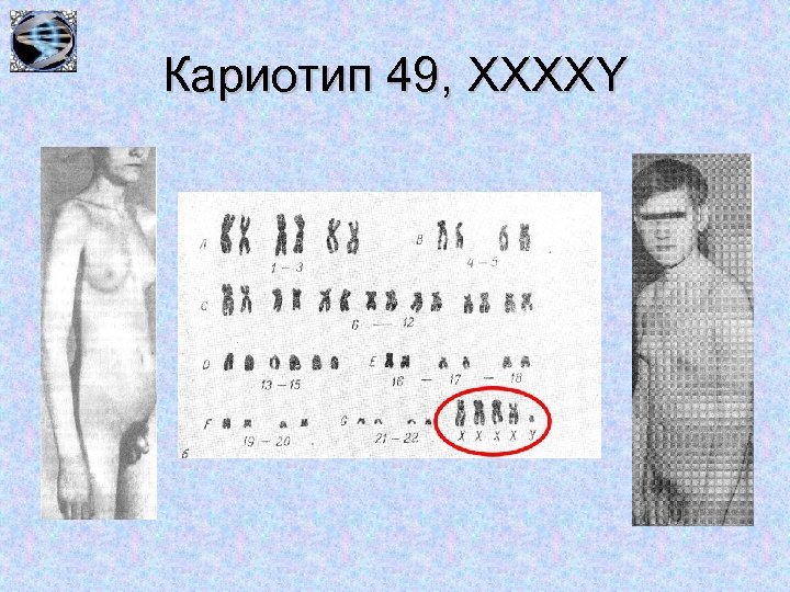 Кариотип 49, XXXXY 