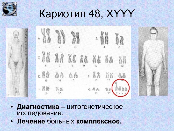 Кариотип 48, XYYY • Диагностика – цитогенетическое исследование. • Лечение больных комплексное. 