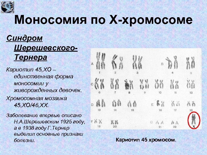 Назовите число хромосом. Моносомия по х-хромосоме синдром Шерешевского -Тернера кариотип 45 Хо. Синдром Шерешевского Тернера кариотип. Моносомия по х-хромосоме кариотип. Кариотип моносомия по х.