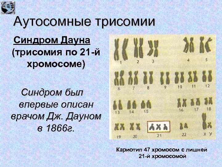 Трисомия 22 хромосомы. Мозаичная форма синдрома Дауна кариотип. Синдром Дауна трисомия 21. Кариотип синдрома Дауна формула.