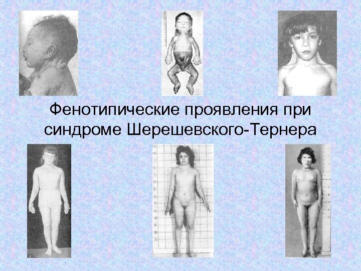 Фенотипические проявления при синдроме Шерешевского-Тернера 