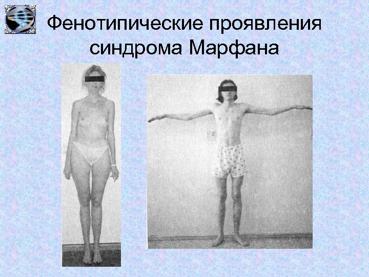 Фенотипические проявления синдрома Марфана 