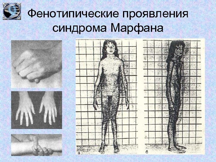 Фенотипические проявления синдрома Марфана 