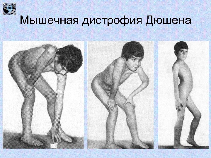 Мышечная дистрофия Дюшена 
