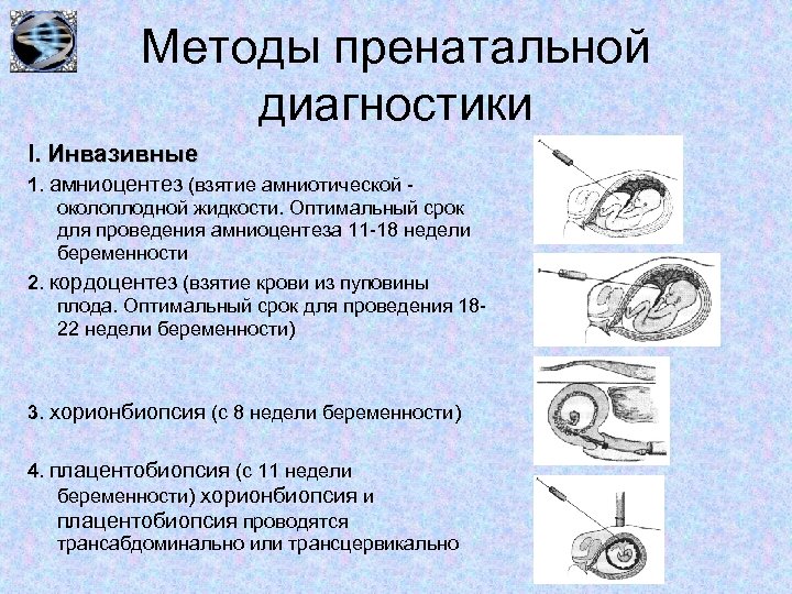 Методы пренатальной диагностики I. Инвазивные 1. амниоцентез (взятие амниотической околоплодной жидкости. Оптимальный срок для