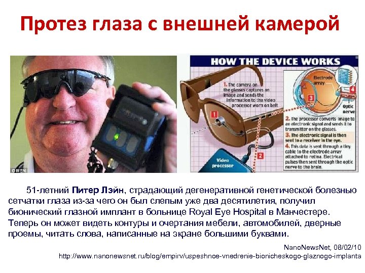 Протез глаза с внешней камерой 51 -летний Питер Лэйн, страдающий дегенеративной генетической болезнью сетчатки