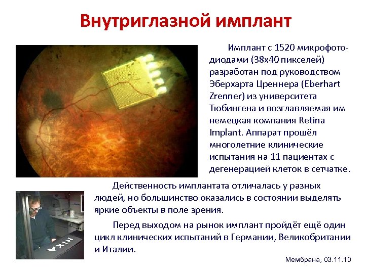 Внутриглазной имплант Имплант с 1520 микрофотодиодами (38 х40 пикселей) разработан под руководством Эберхарта Цреннера