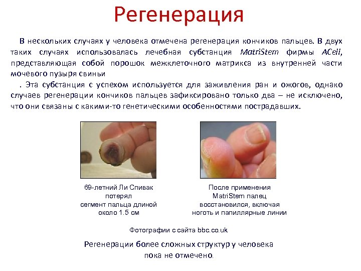 Регенерация В нескольких случаях у человека отмечена регенерация кончиков пальцев. В двух таких случаях