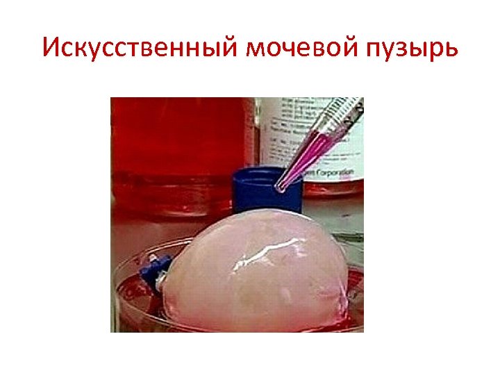 Искусственный мочевой пузырь 