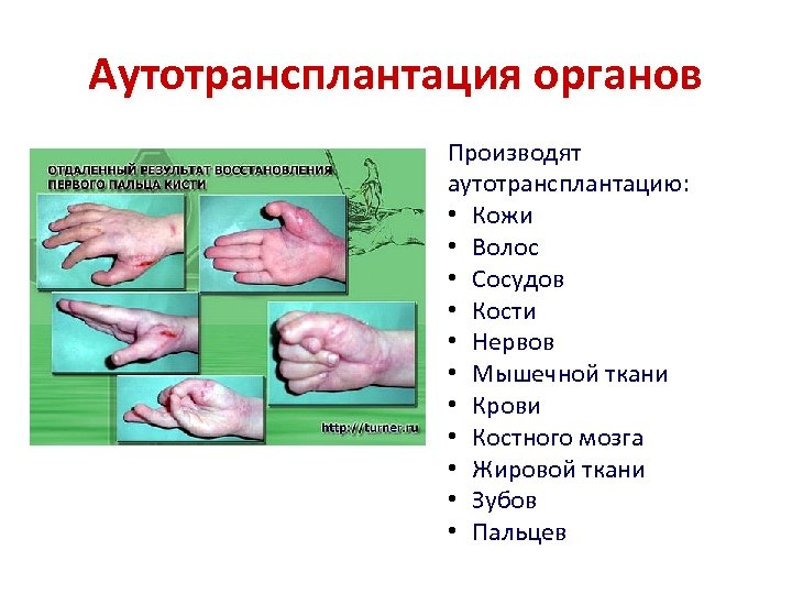 Аутотрансплантация органов Производят аутотрансплантацию: • Кожи • Волос • Сосудов • Кости • Нервов