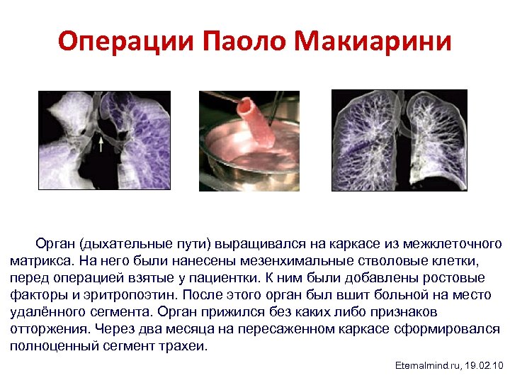 Операции Паоло Макиарини Орган (дыхательные пути) выращивался на каркасе из межклеточного матрикса. На него