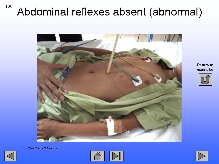 100 Abdominal reflexes absent (abnormal) Return to examples Photo Credit: T Solomon 
