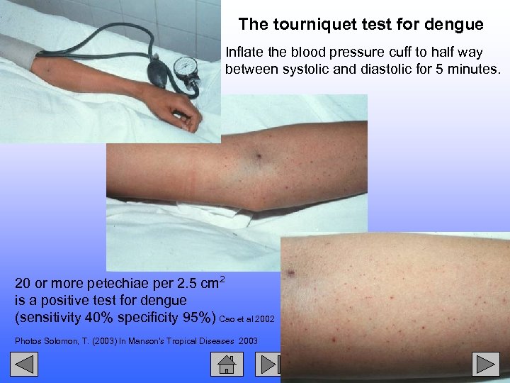 10 7 The tourniquet test for dengue Inflate the blood pressure cuff to half