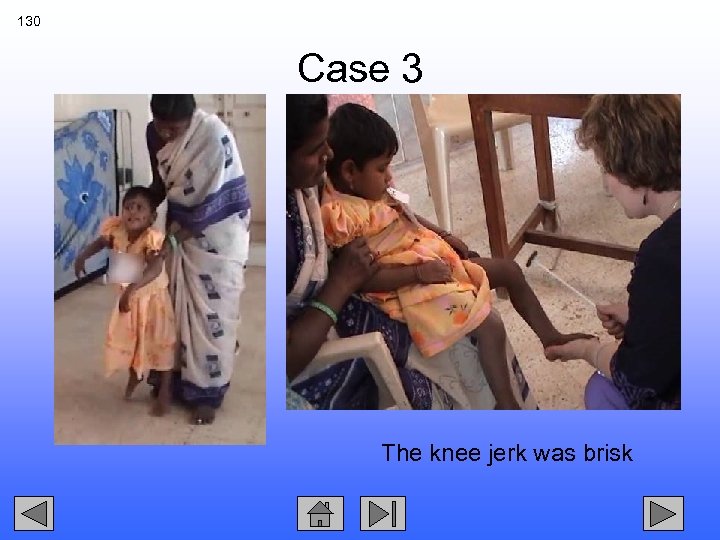 130 Case 3 The knee jerk was brisk 