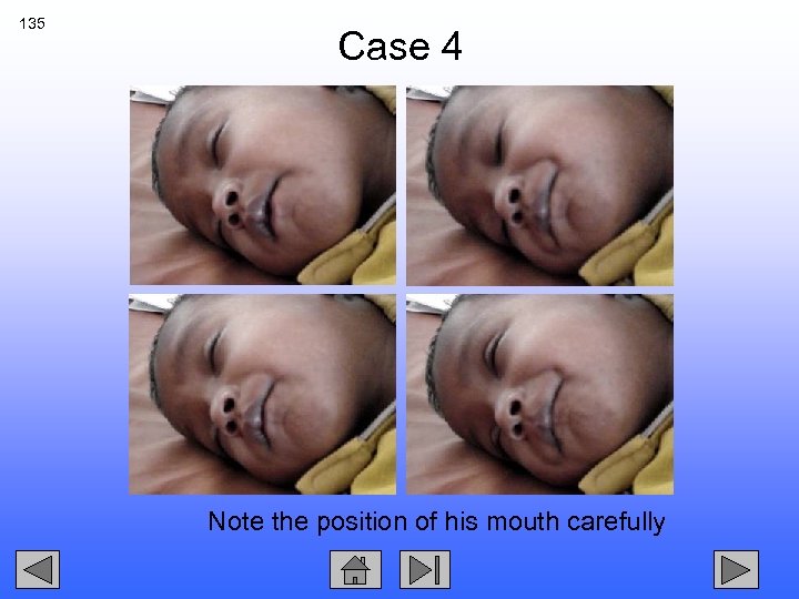 135 Case 4 Note the position of his mouth carefully 