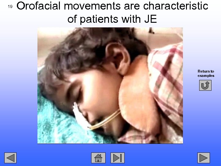 19 Orofacial movements are characteristic of patients with JE Return to examples 