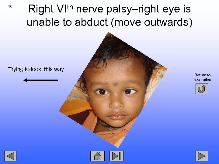 40 Right VIth nerve palsy–right eye is unable to abduct (move outwards) Trying to