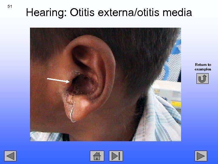 51 Hearing: Otitis externa/otitis media Return to examples 
