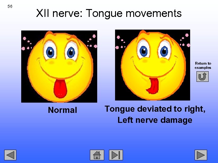 56 XII nerve: Tongue movements Return to examples Normal Tongue deviated to right, Left