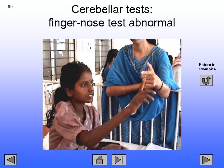 60 Cerebellar tests: finger-nose test abnormal Return to examples 