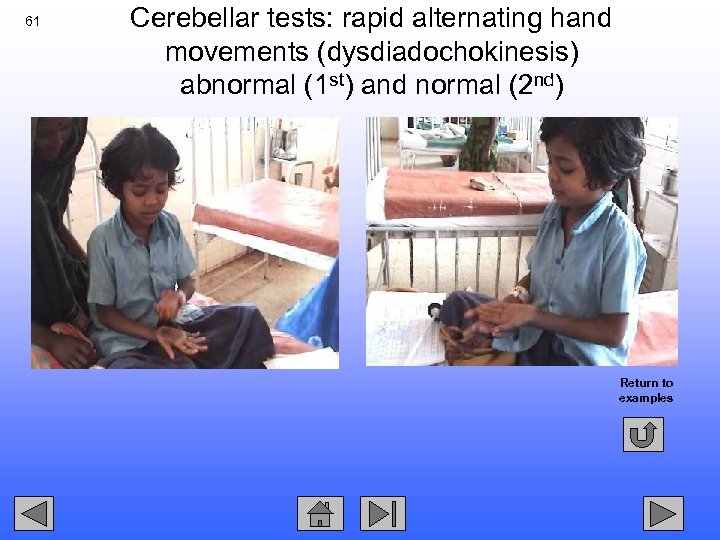 61 Cerebellar tests: rapid alternating hand movements (dysdiadochokinesis) abnormal (1 st) and normal (2