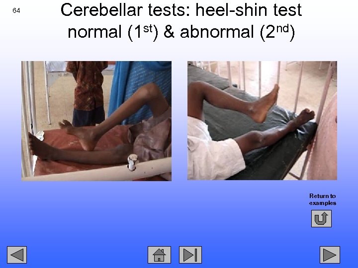 64 Cerebellar tests: heel-shin test normal (1 st) & abnormal (2 nd) Return to