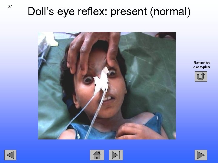 67 Doll’s eye reflex: present (normal) Return to examples 