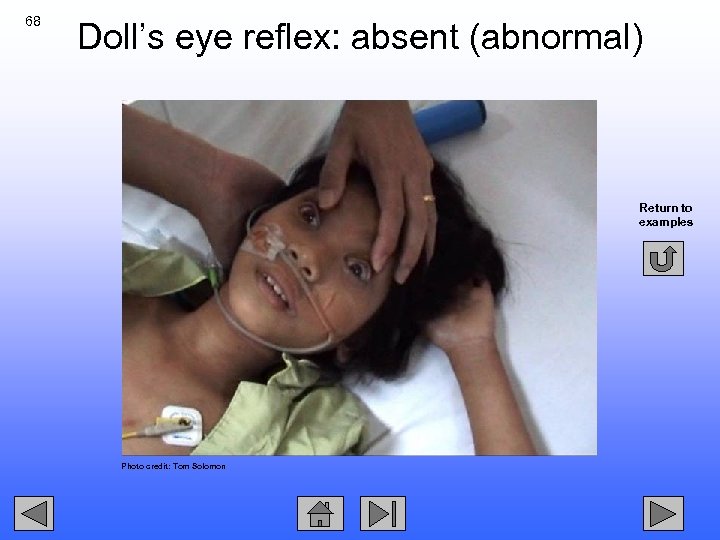 68 Doll’s eye reflex: absent (abnormal) Return to examples Photo credit: Tom Solomon 