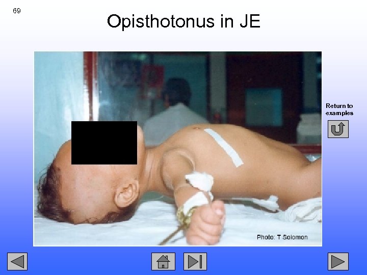 69 Opisthotonus in JE Return to examples 