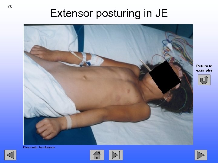 70 Extensor posturing in JE Return to examples Photo credit: Tom Solomon 