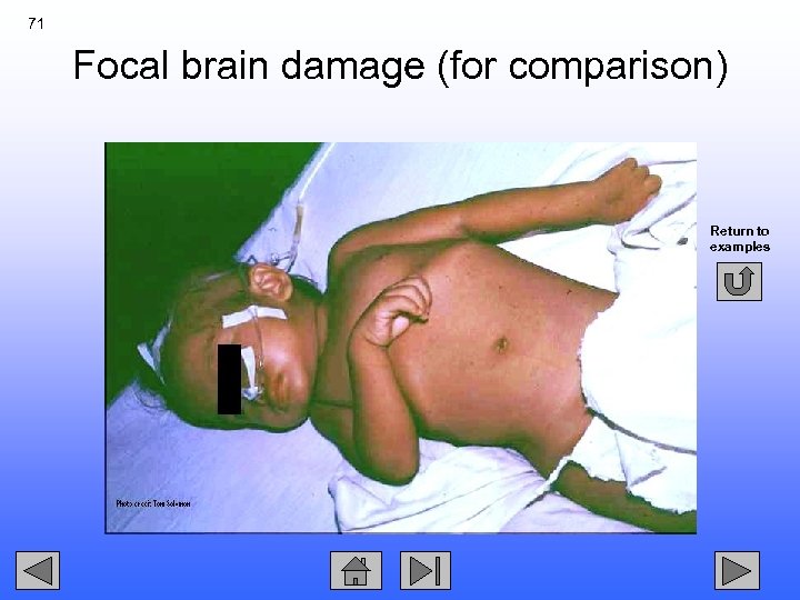71 Focal brain damage (for comparison) Return to examples 