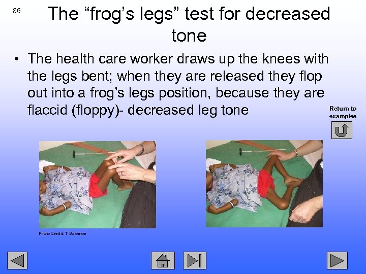 86 The “frog’s legs” test for decreased tone • The health care worker draws