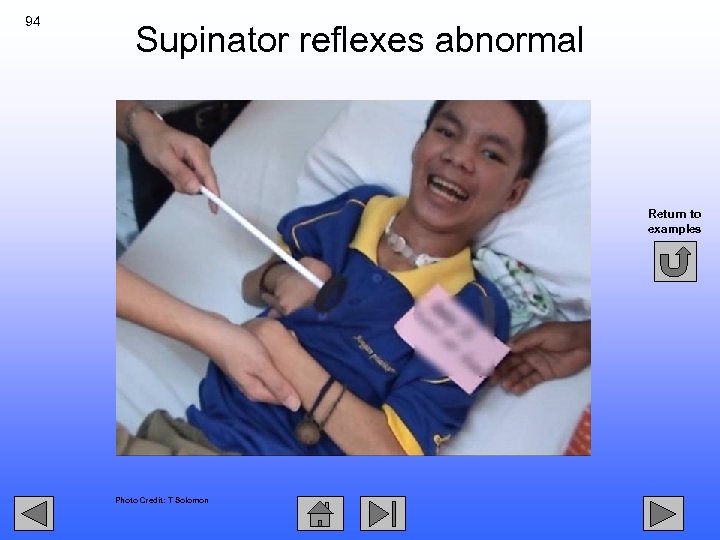94 Supinator reflexes abnormal Return to examples Photo Credit: T Solomon 