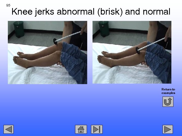 95 Knee jerks abnormal (brisk) and normal Return to examples 