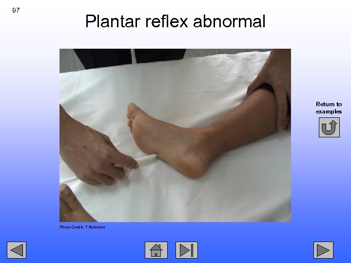97 Plantar reflex abnormal Return to examples Photo Credit: T Solomon 