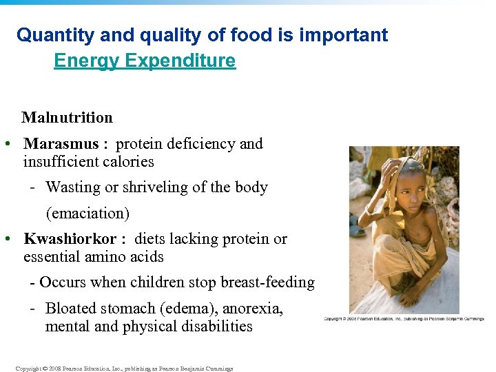 Quantity and quality of food is important Energy Expenditure Malnutrition • Marasmus : protein