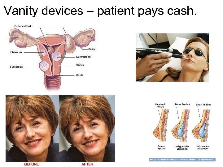 Vanity devices – patient pays cash. 