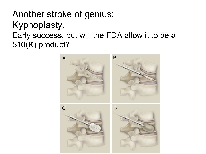 Another stroke of genius: Kyphoplasty. Early success, but will the FDA allow it to