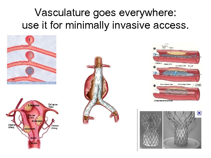 Vasculature goes everywhere: use it for minimally invasive access. 