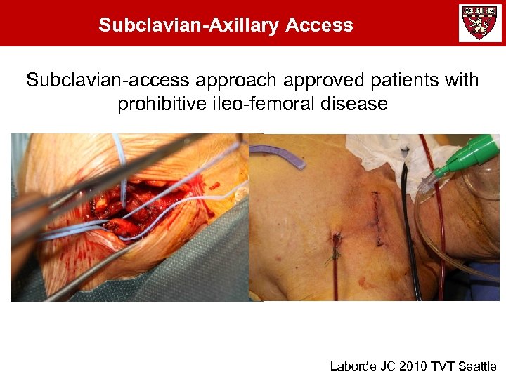 Subclavian-Axillary Access Subclavian-access approach approved patients with prohibitive ileo-femoral disease Laborde JC 2010 TVT