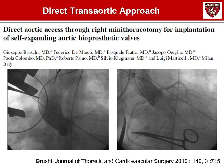 Direct Transaortic Approach Brushi Journal of Thoracic and Cardiovascular Surgery 2010 ; 140, 3