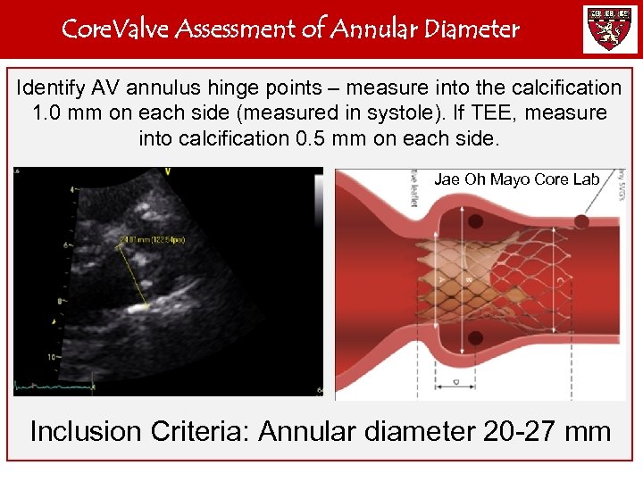 Core. Valve Assessment of Annular Diameter Identify AV annulus hinge points – measure into