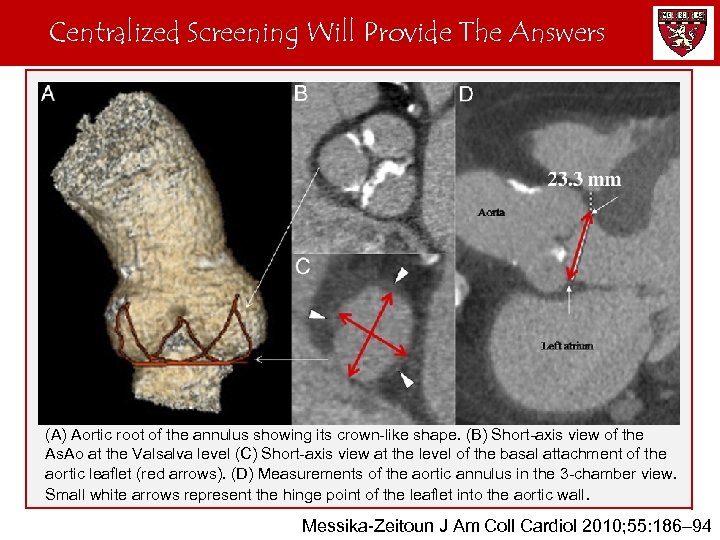Centralized Screening Will Provide The Answers CT Measurement of the Aortic Annulus (A) Aortic