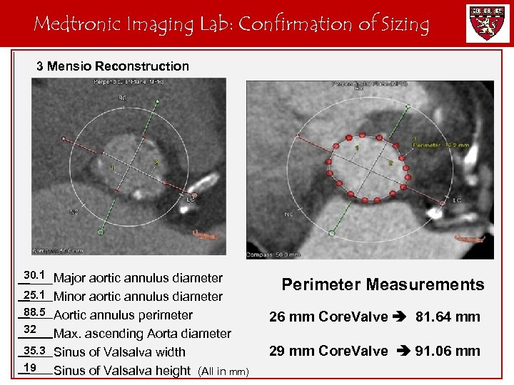 Medtronic Imaging Lab: Confirmation of Sizing 3 Mensio Reconstruction 30. 1 Major aortic annulus