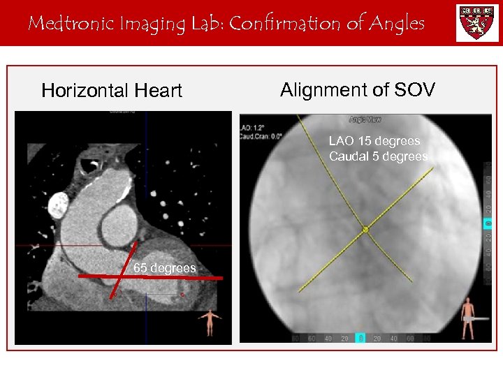 Medtronic Imaging Lab: Confirmation of Angles Horizontal Heart Alignment of SOV LAO 15 degrees