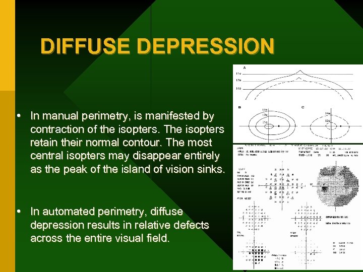 DIFFUSE DEPRESSION • In manual perimetry, is manifested by contraction of the isopters. The