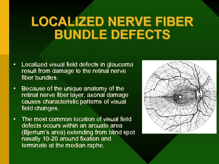 LOCALIZED NERVE FIBER BUNDLE DEFECTS • Localized visual field defects in glaucoma result from