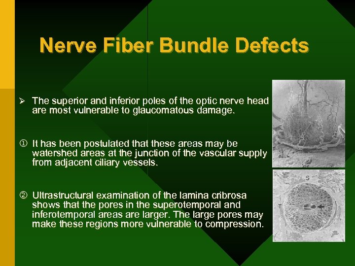 Nerve Fiber Bundle Defects Ø The superior and inferior poles of the optic nerve
