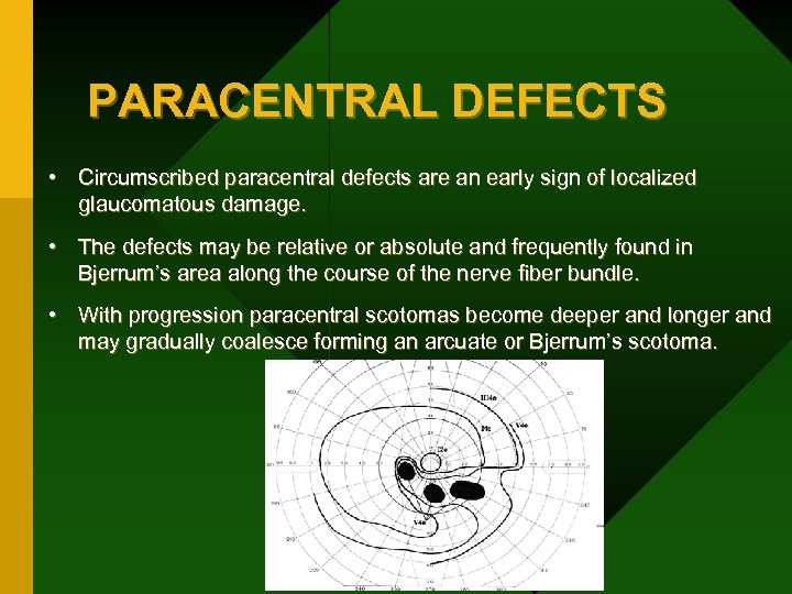 PARACENTRAL DEFECTS • Circumscribed paracentral defects are an early sign of localized glaucomatous damage.